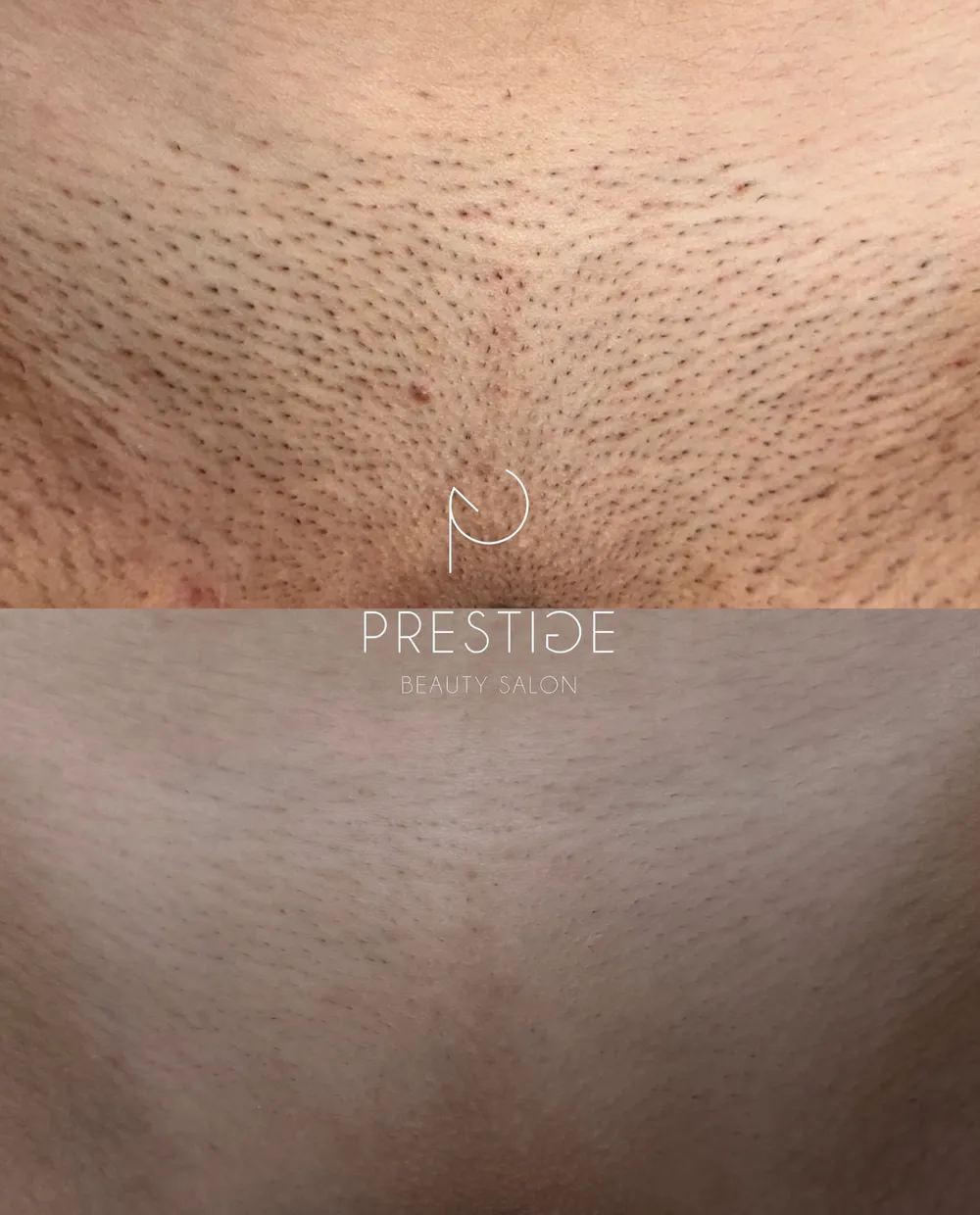 Epilare definitivă cu laser la Prestige Beauty Salon